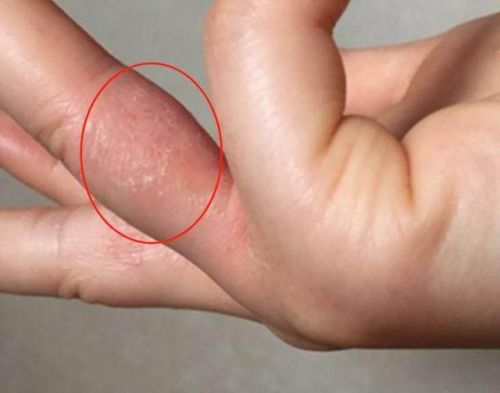 脚底长了像水泡一样的东西很痒(脚底起红点点还痒怎么回事)插图2 脚底长了像水泡一样的东西很痒(脚底起红点点还痒怎么回事)插图2