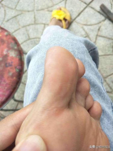 脚上起小水泡还很痒是怎么回事(脚上怎么分辨是湿疹还是脚气)插图 脚上起小水泡还很痒是怎么回事(脚上怎么分辨是湿疹还是脚气)插图