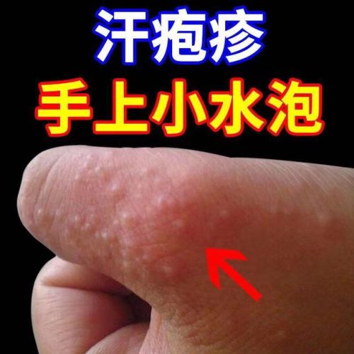 脚底长了像水泡一样的东西很痒(脚底起红点点还痒怎么回事)插图 脚底长了像水泡一样的东西很痒(脚底起红点点还痒怎么回事)插图