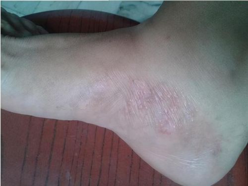 脚底长了像水泡一样的东西很痒(脚底起红点点还痒怎么回事)插图3 脚底长了像水泡一样的东西很痒(脚底起红点点还痒怎么回事)插图3