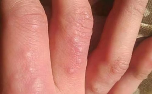 脚底长了像水泡一样的东西很痒(脚底起红点点还痒怎么回事)插图1 脚底长了像水泡一样的东西很痒(脚底起红点点还痒怎么回事)插图1