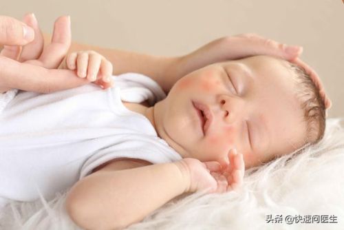 宝宝身上出现很多小红疹怎么办(婴儿捂热的疹子图片)插图1